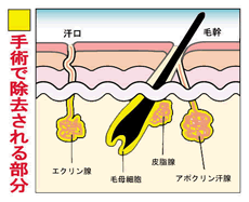 ワキガの臭い