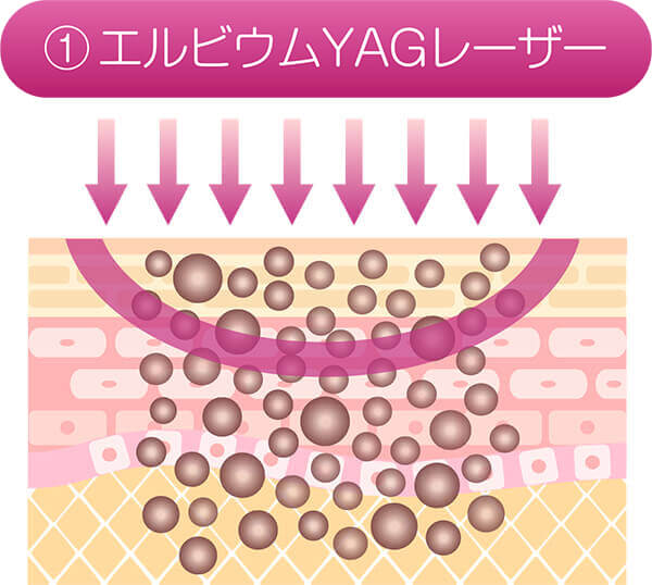 ①エルビウムYAGレーザー