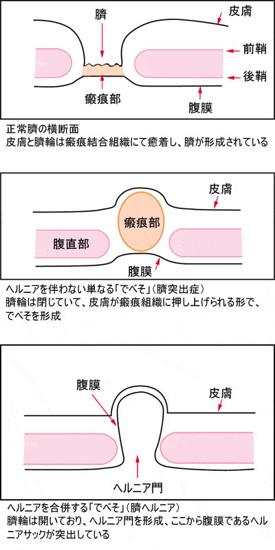 でべそ 埼玉の美容整形外科 美容皮膚科なら大宮中央クリニック