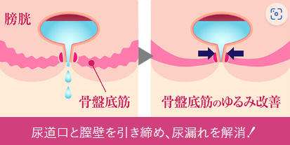 尿漏れレーザー治療